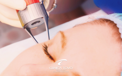 Laser Fracionado Funciona para Marcas de Acne e Cicatrizes?