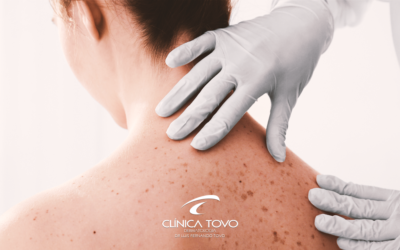 Câncer da Pele: O que é?