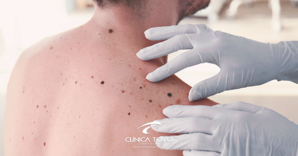 informações sobre melanoma