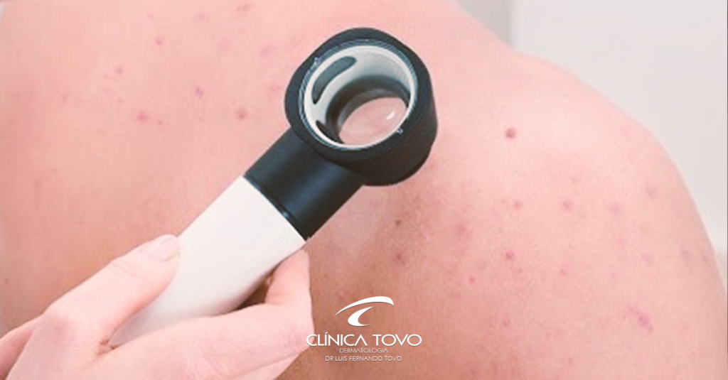 Câncer de pele não melanoma