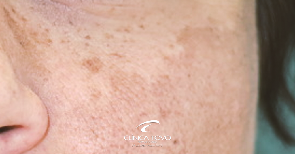 Novidades no Tratamento de Melasma