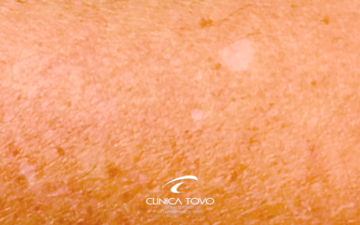 Tratamento das chamadas “sardas brancas” (leucodermia puntata) nos braços e pernas