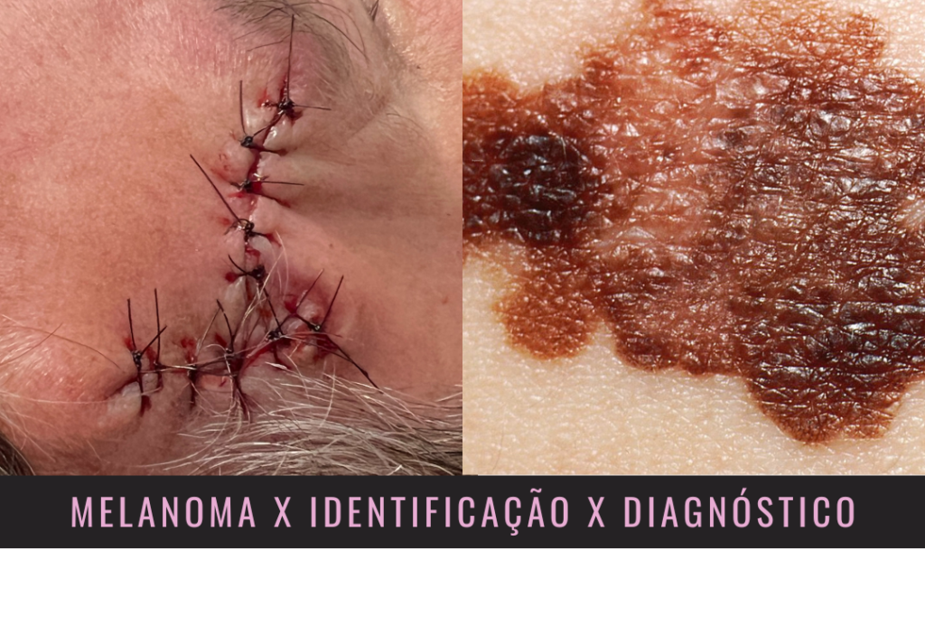 melanoma identificação e diagnóstico