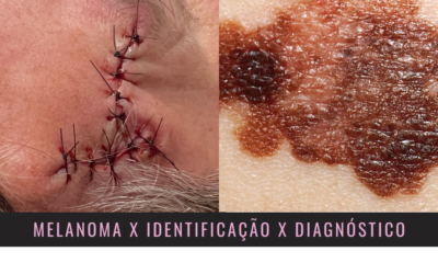 Guerra ao Melanoma – War On Melanoma