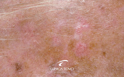 Prevenção e Tratamento da Queratose Actínica