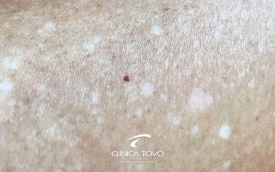 Sardas Brancas nas pernas e braços Leucodermia Puntata dr tovo clinica tovo