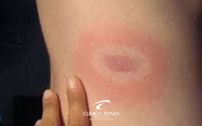 Doença de Lyme – Justin Bieber diagnóstico.