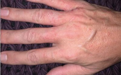 DERMATITE DE MÃOS em tempos de Quarentena COVID-19.