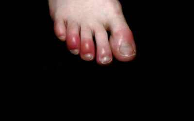 LESÕES DERMATOLÓGICAS NO COVID-19. O que é o dedo Covid (Covid Toe)?