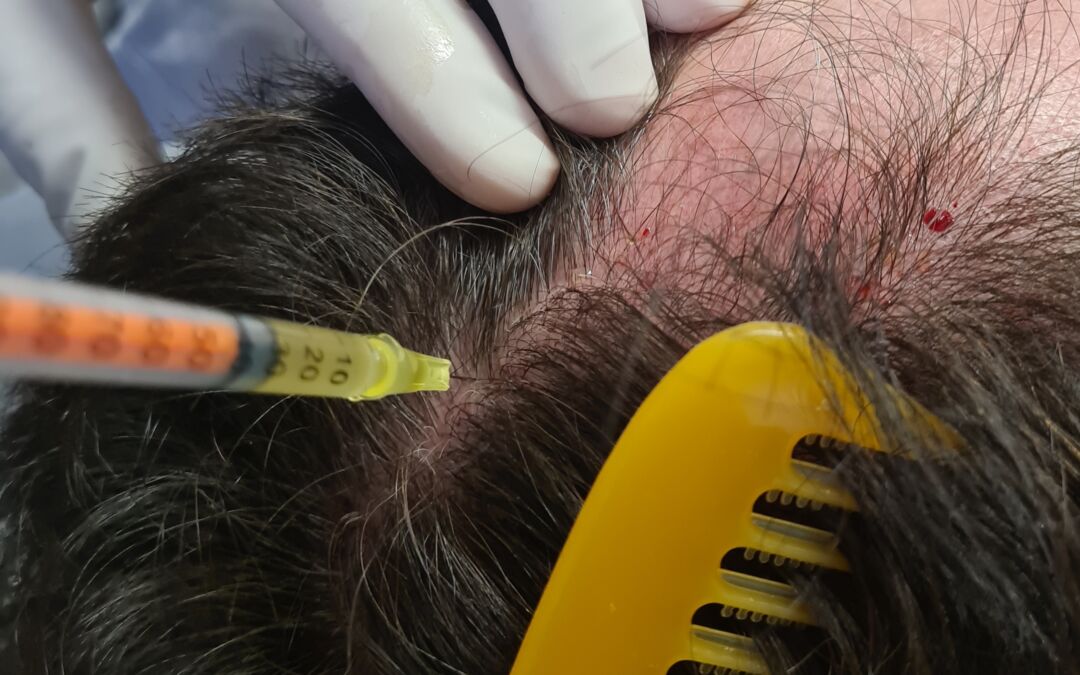 Calvície e queda de cabelo: PRP Plasma Rico em Plaquetas tratamento.