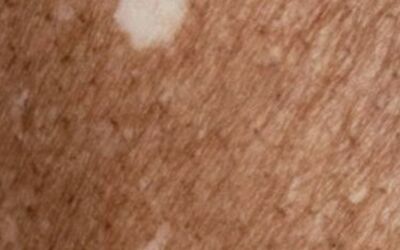 Sardas Brancas ou Leucodermia puntata: enfim uma opção de tratamento