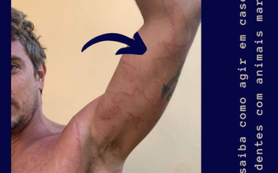 QUEIMADURAS CAUSADAS POR ANIMAIS MARINHOS E ÁGUA VIVA NO VERÃO