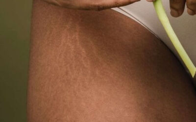 ESTRIAS NA PELE | prevenção e tratamentos