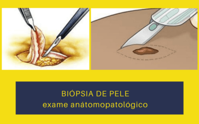 BIÓPSIA DE PELE: dr vai para biópsia?