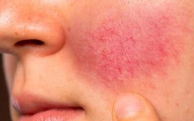 ROSÁCEA: o que é? Como diagnosticar? Quando procurar um dermatologista?
