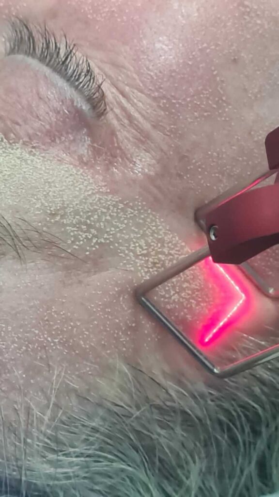 Rejuvenescimento das pálpebras e contorno dos olhos | LASER