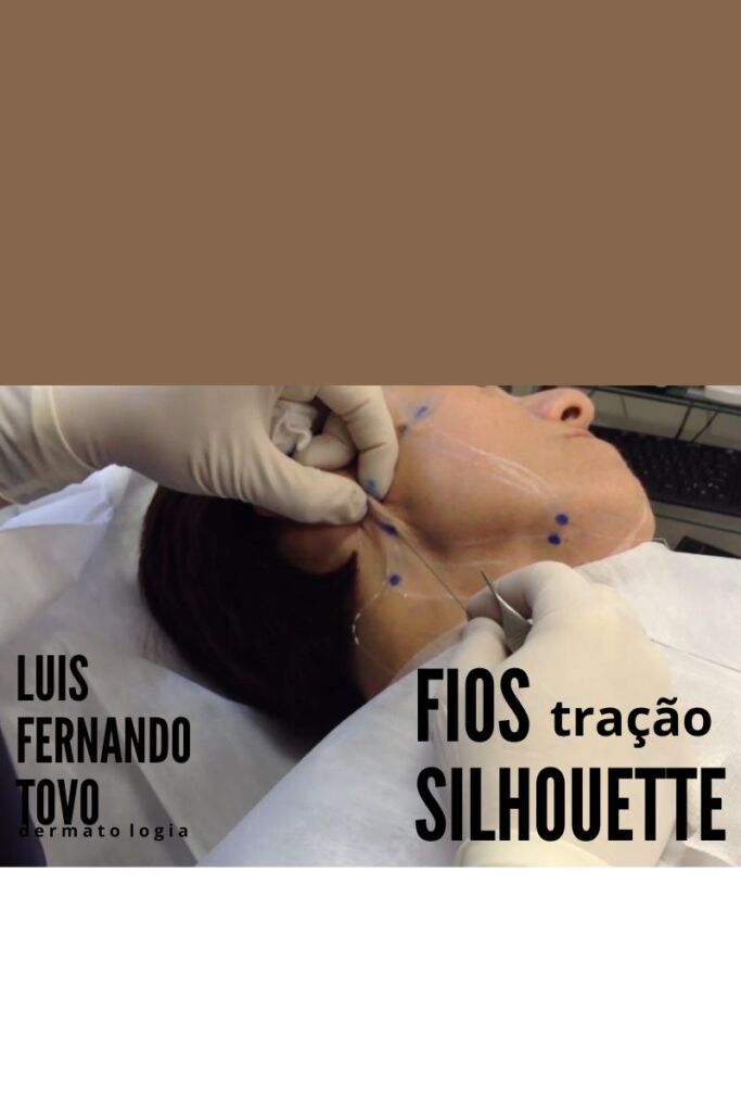 fios de tração silhouette soft tovo