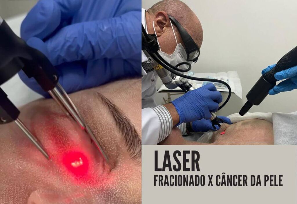 Laser Fracionado e Cãncer da pele dr tovo luis fernando tovo clinica tovo dermatologia