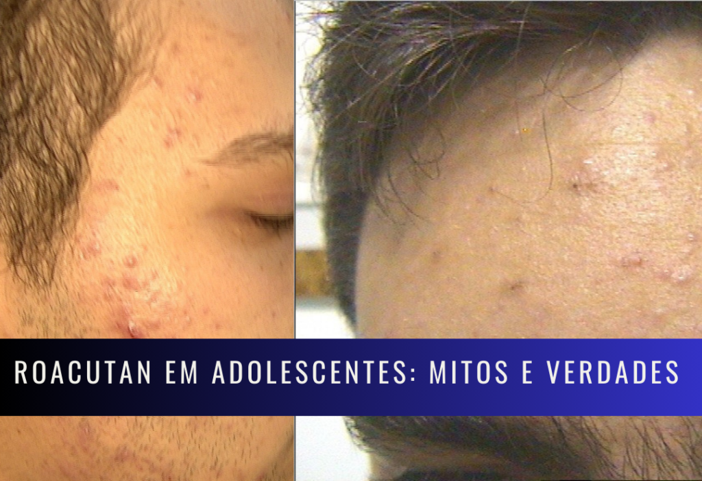 roacutan e alterações emocionais
