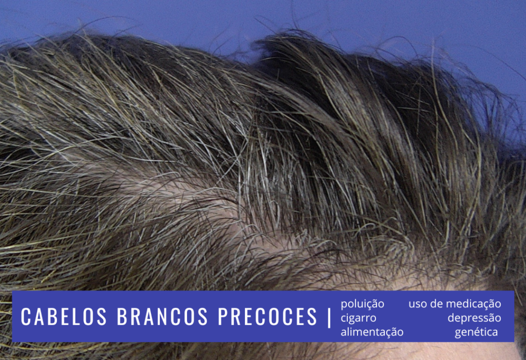 cabelos brancos precoce tovo dermatologista