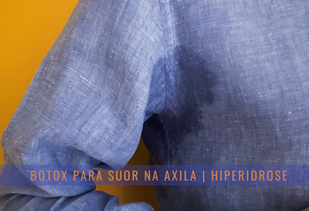 botox na axila hiperidrose dr tovo luis fernando tovo