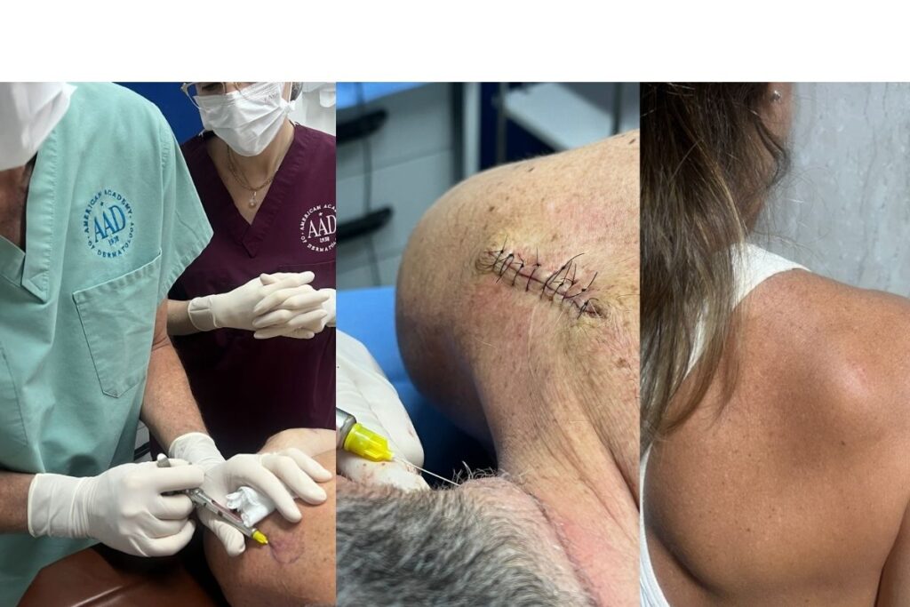 lipoma o que é e como tratar dr tovo luis fernando tovo clinica dr tovo de dermatologia