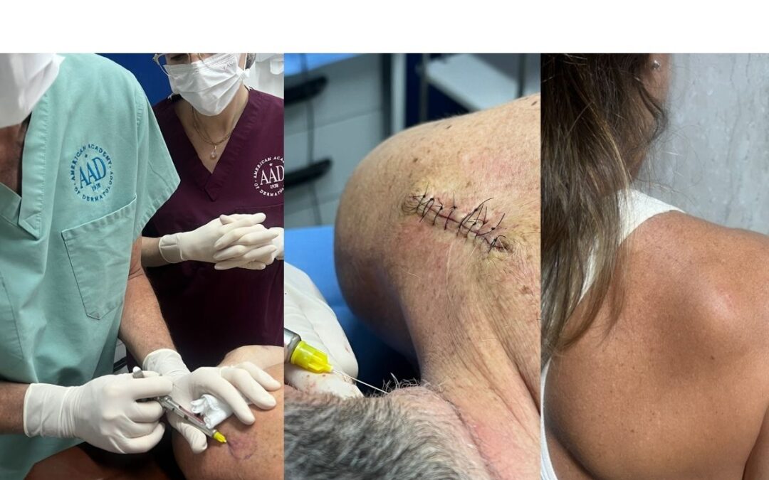 lipoma o que é e como tratar dr tovo luis fernando tovo clinica dr tovo de dermatologia