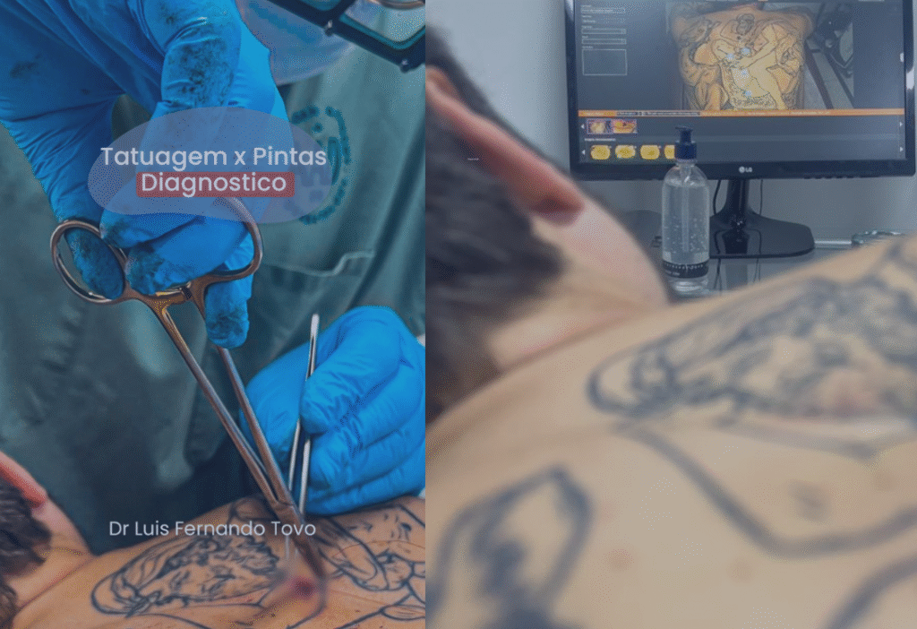 tatuagem pintas diagnostico cancer da pele