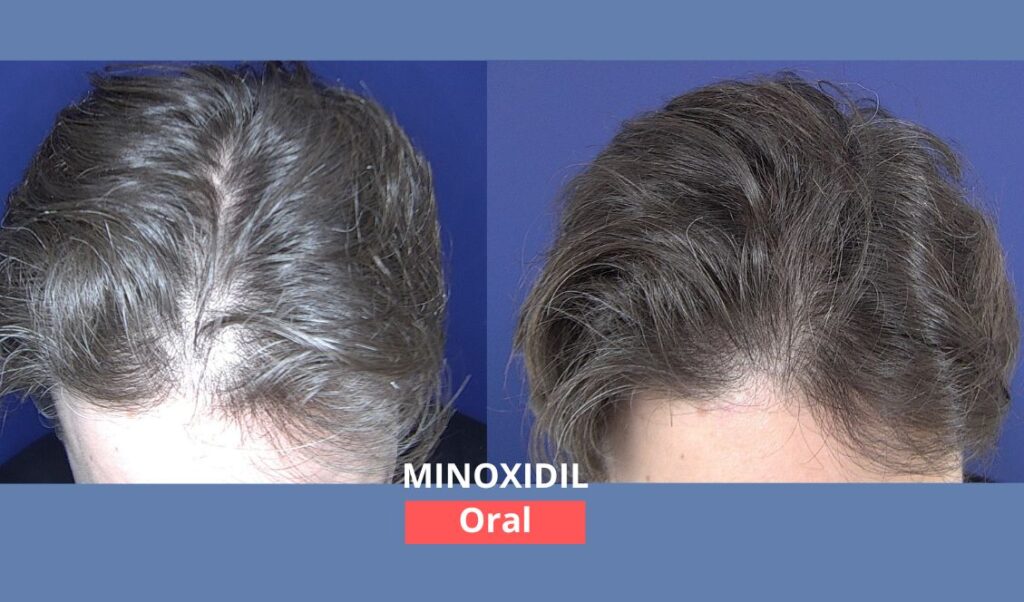 minoxidil oral dr tovo dermatologista
