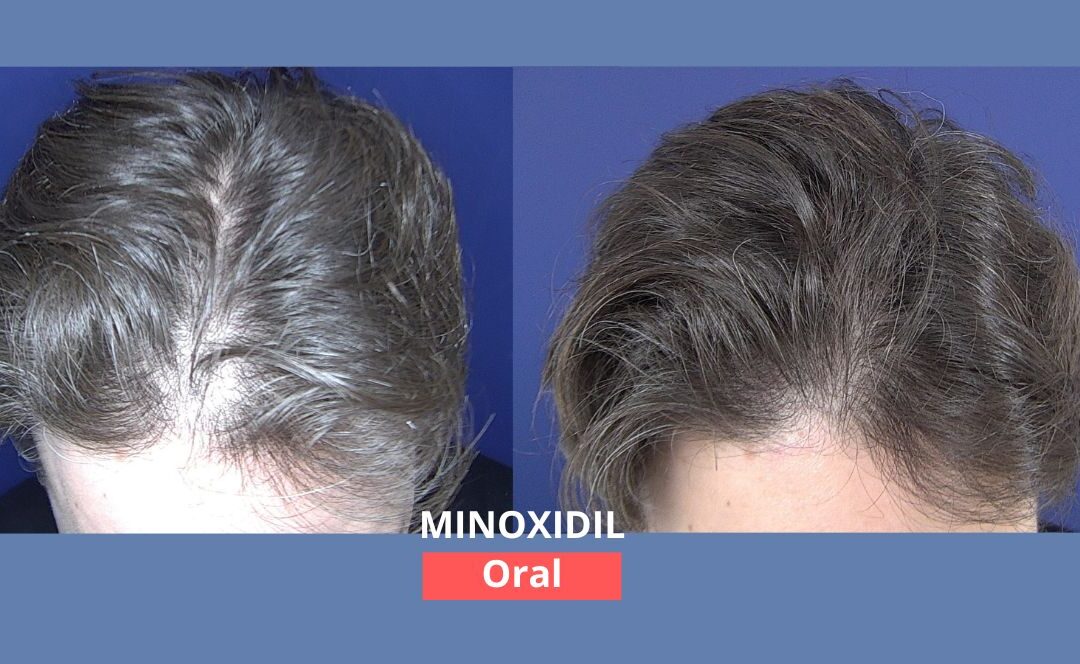 Minoxidil oral