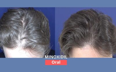 Minoxidil oral